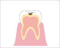 『エナメル質までのむし歯』C1