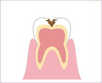 『象牙質までのむし歯』C2