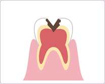 『歯の神経までのむし歯』C3